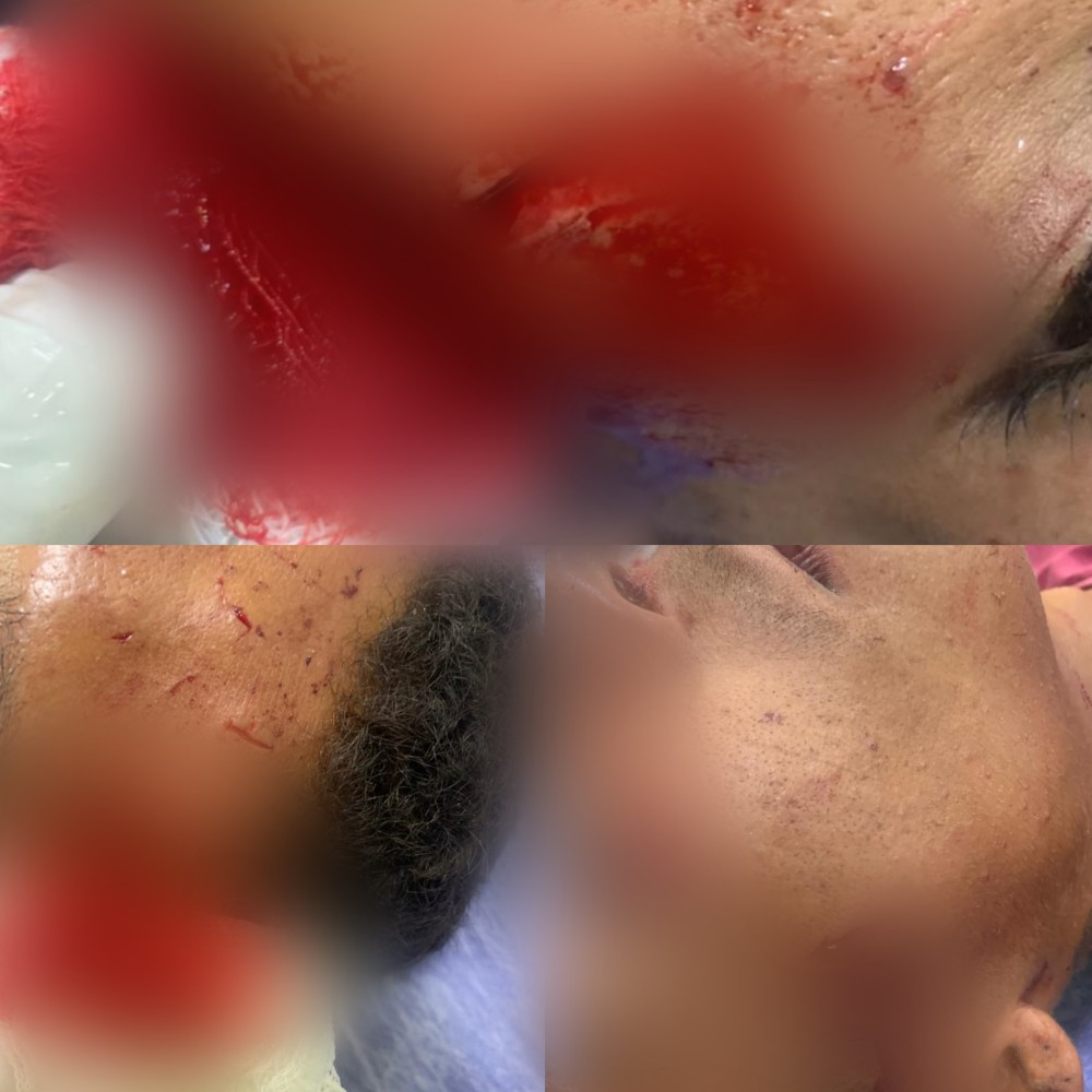 Jovem é atingido por garrafada e sofre cortes no rosto no bairro da Mansão em Conceição do Coité