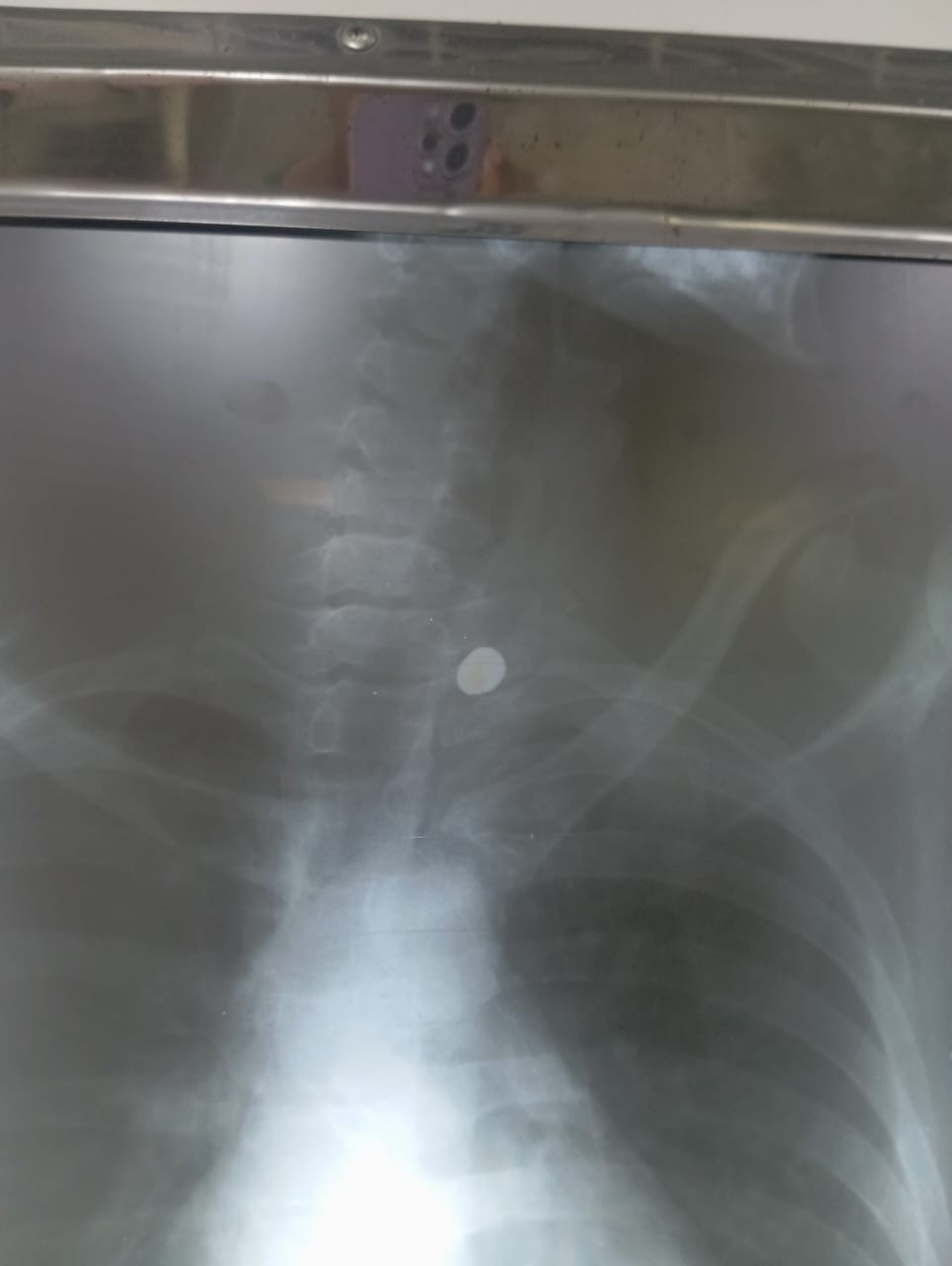 Jovem baleado em ação da PRE em Conceição do Coité recebe alta, sofre fraturas e volta para casa com projétil no corpo; cirurgia poderia causar tetraplegia