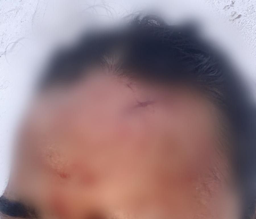 Mulher sofre cortes no rosto após agressão com copo de vidro pela 'melhor amiga' no bairro Alto da Colina em Conceição do Coité