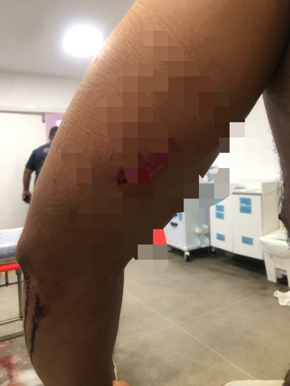 Homem fica ferido após cair de andaime de obra em Conceição do Coité; vítima foi perfurada por estrutura de aço enferrujada