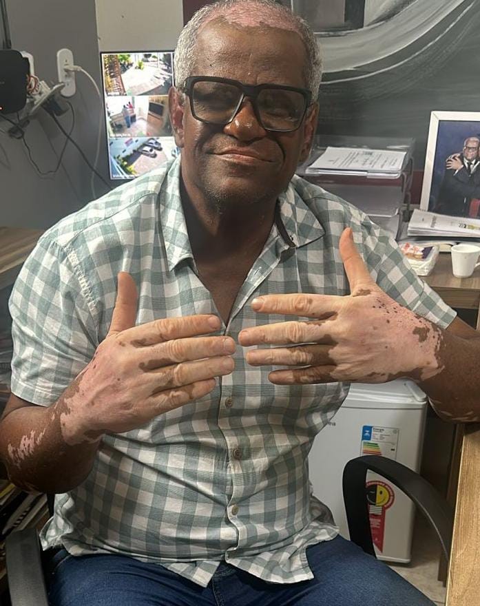 Coité: Portador de vitiligo, presidente da Câmara de Vereadores relata comentários preconceituosos e dispara: 