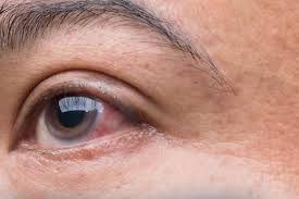 Coité: 300 pacientes fazem acompanhamento pelo SUS após diagnóstico de glaucoma; prefeitura realiza mutirão dia 10 de fevereiro